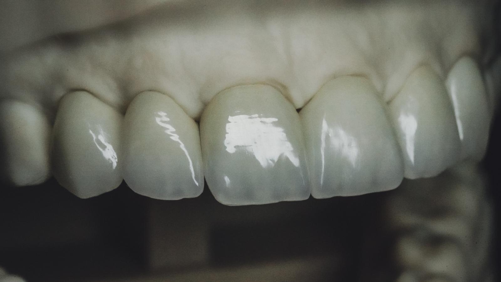 Prótese em porcelana